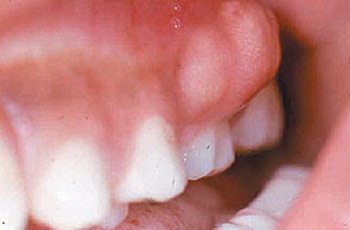 آبسه(دندان درد) / Abscess-Toothache